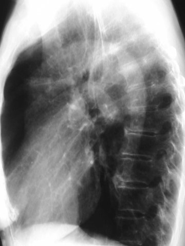 lung congenital disease